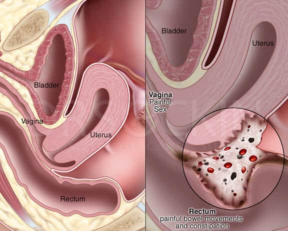 I get pain during sex – is it endometriosis or something else?