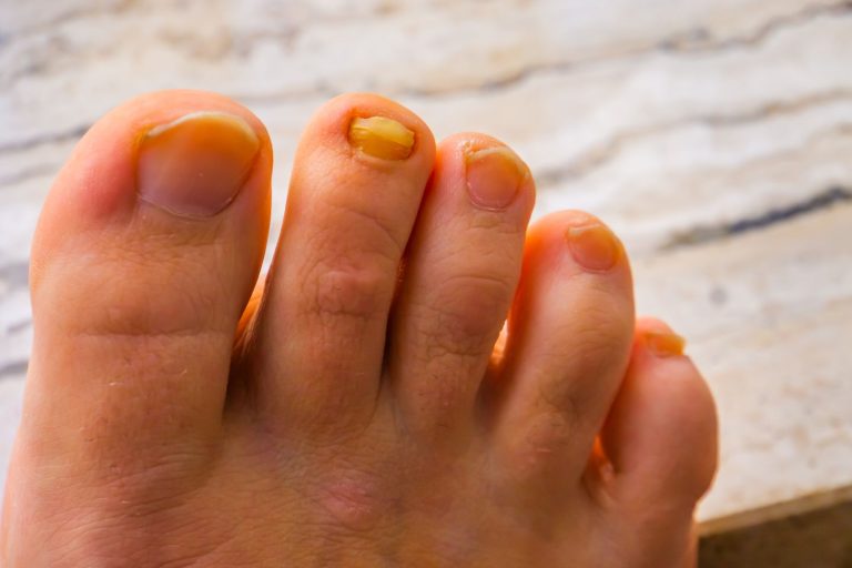 Why Is My Toenail Yellow? Signs You Shouldn't Ignore 2026