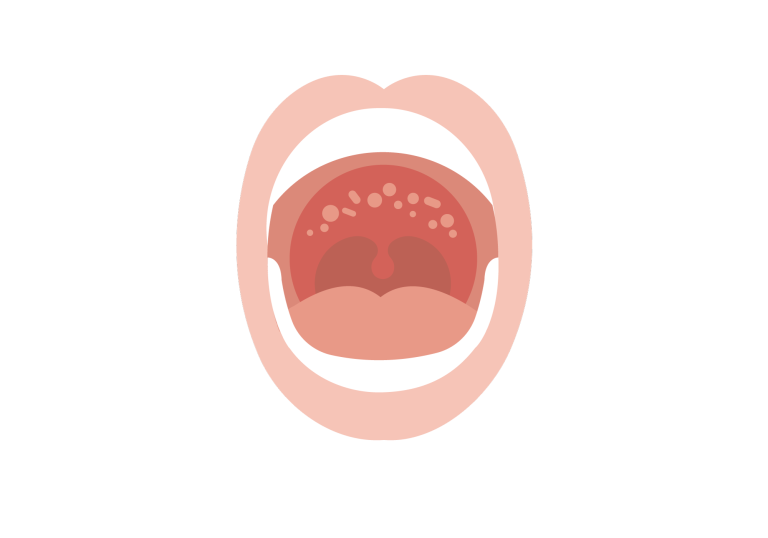 Why Does the Top of My Mouth Hurt Explained by Experts 2026