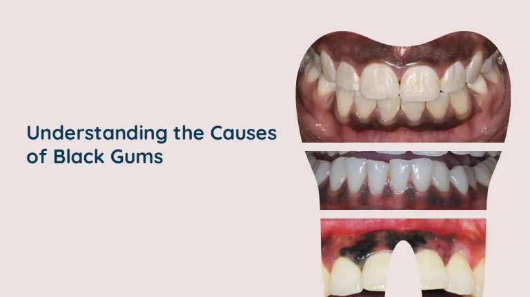 Why Are My Gums Black? Causes & Treatments 2026