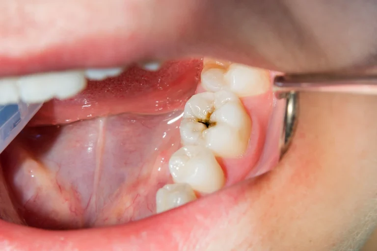 Why Does My Teeth Hurt When I Bite Down? Dentist Tips 2026 Why Does My Teeth Hurt When I Bite Down? Dentist Tips 2026