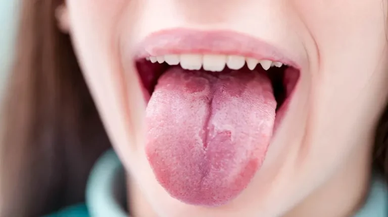 Why Does My Tongue Have Cracks? Causes & Treatment 2026