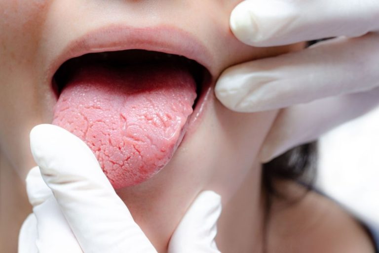 Why Do I Have Bumps on My Tongue? Common Reasons 2026 Why Do I Have Bumps on My Tongue? Common Reasons 2026