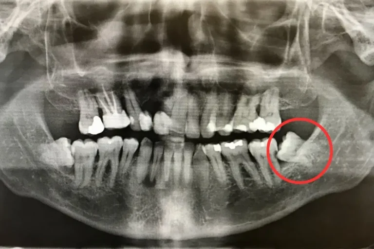 Why Experts Now Say Not to Remove Your Wisdom Teeth: Guide 2026