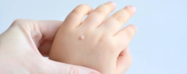 Why Do Kids Get Warts? What Parents Need to Know in 2026