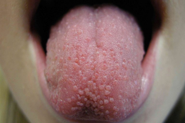 Why Are My Taste Buds Swollen? Symptoms & Fixes 2026