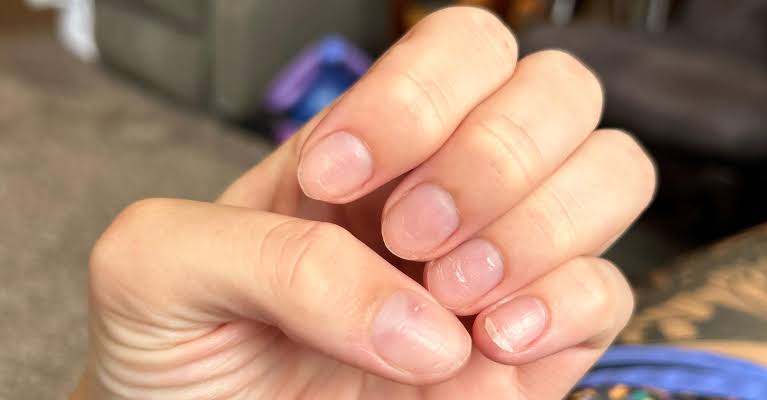 Why Do My Nails Hurt After Getting Acrylics? (Causes & Relief) 2026