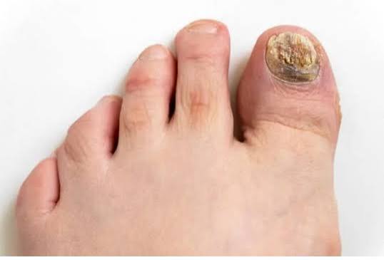 Why Do Toenails Turn Yellow? Causes Explained 2026