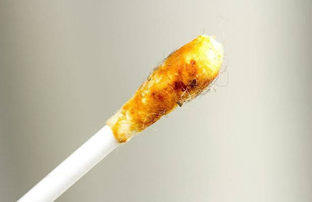 Why Is My Earwax Wet? Causes, Normal Types, and Warning Signs 2026