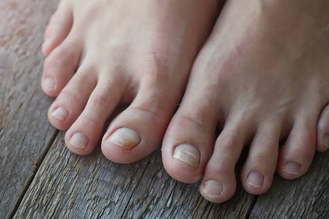 Why Do Toenails Turn Yellow? Causes Explained 2026