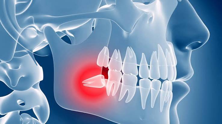 Why Is It Called Wisdom Teeth? The Real Origin Explained 2026