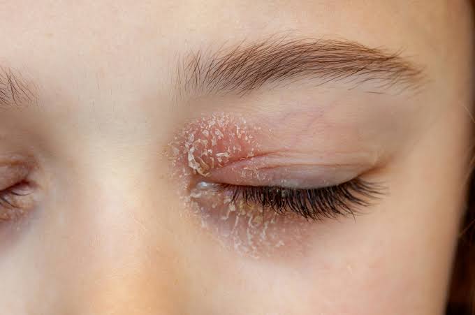 Why Do My Eyelids Itch? Common Causes Explained 2026