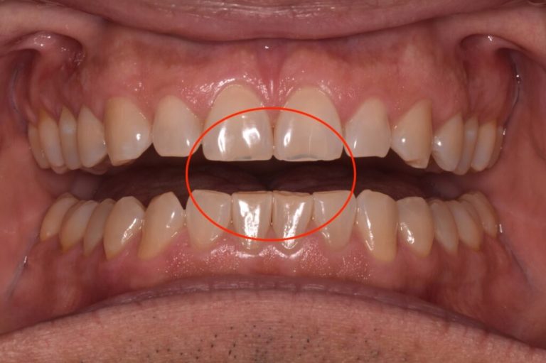 Why Are My Teeth Transparent? Causes & Fixes 2026