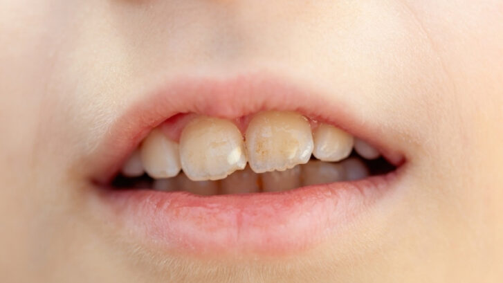 Why Is There a White Spot on My Tooth? Explained 2026