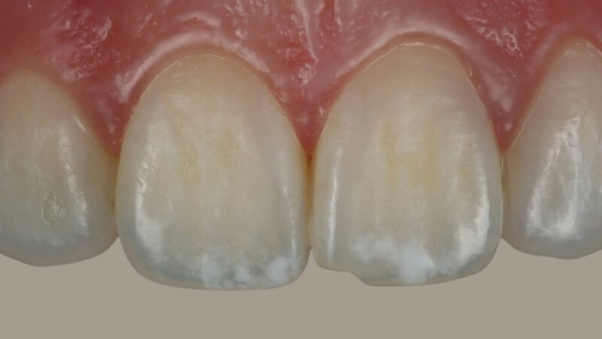 Why Is There a White Spot on My Tooth? Explained 2026
