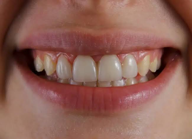 Why Are My Gums Purple? Causes & What It Means 2026