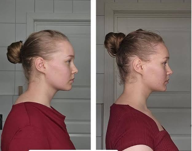 Why Do I Have a Hump on the Back of My Neck? Causes & Fixes 2026