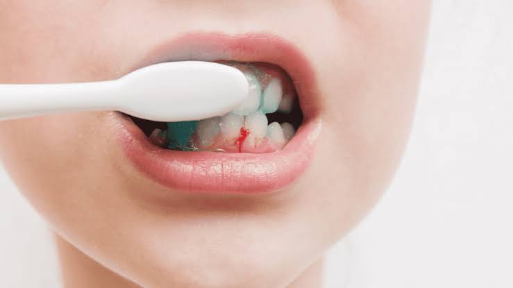 Why Are My Gums Bleeding When I Brush My Teeth? Here's Why 2026