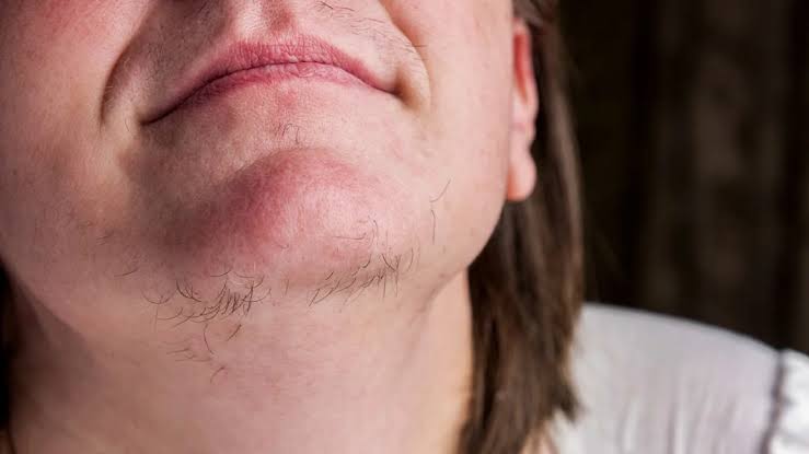 Why Am I So Hairy? Hormones, Genetics & More 2026