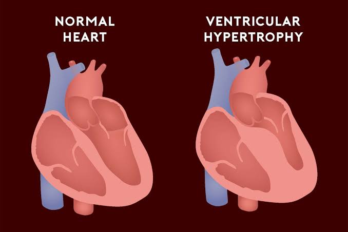 Why Is the Left Ventricle Thicker Than the Right? Key Facts 2026