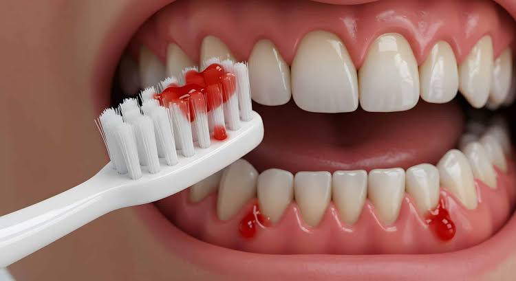 Why Are My Gums Bleeding When I Brush My Teeth? Here's Why 2026