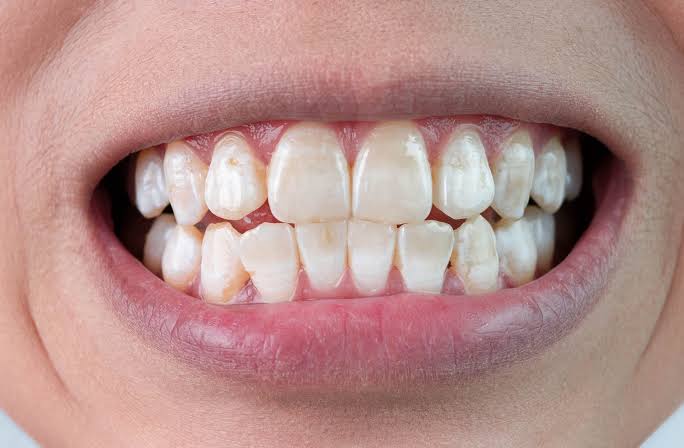 Why Is There a White Spot on My Tooth? Explained 2026
