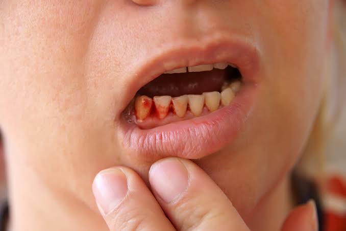 Why Are My Gums Bleeding When I Brush My Teeth? Here's Why 2026